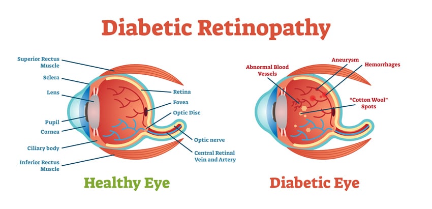 diabetic retinopathy | Jacksonville FL